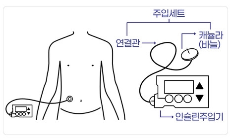 인슐린주입기(인슐린펌프)는 당뇨병 치료를 위해 체외에서 자동으로 인슐린을 주입해 혈당을 조절하는 기기다. (출처:식품의약품안전처) 