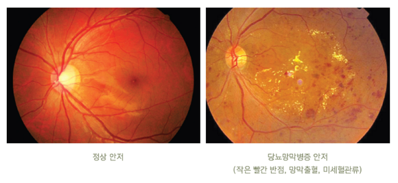 출처: 성모안과병원 