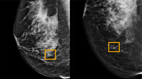 구글의 검진 AI가 찾아낸 유방암 조직. 