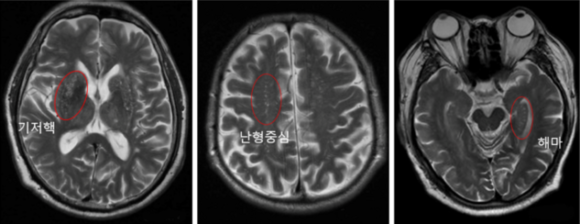 뇌 MRI 이미지. 뇌혈관 주위 공간 확장 정도가 심할 경우 인지기능이 빠르게 악화되는데, 특히 난형중심 부위의 뇌혈관주위 공간확장 정도가 심한 환자군은 그렇지 않은 환자군에 비해 매년 인지 점수가 0.58점씩 빠르게 감소한다. 