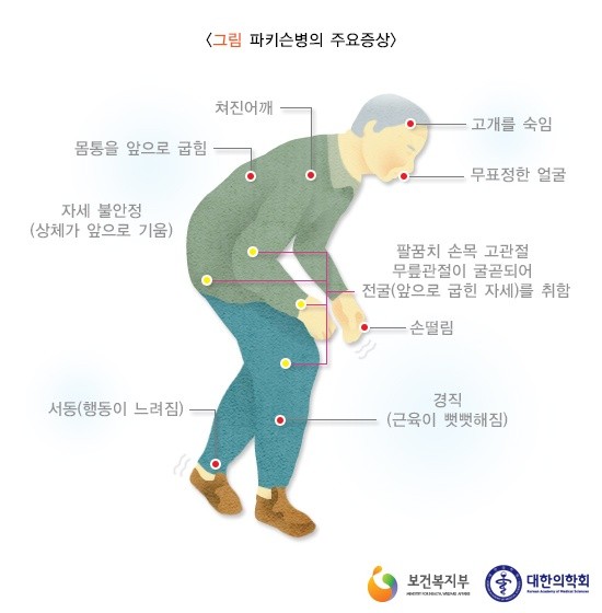 파킨슨병 주요 증상 (출처=보건복지부, 대한의학회) 